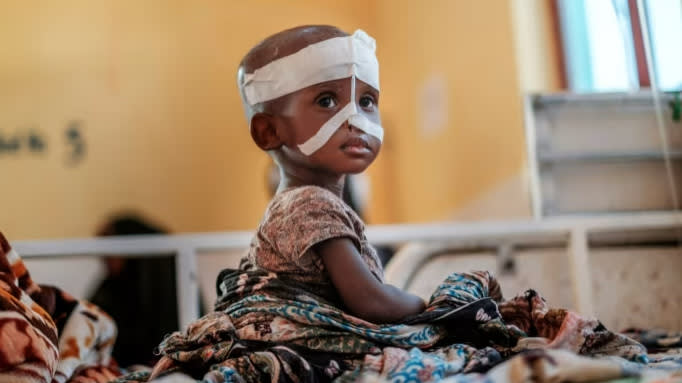 Malnutrition crisis threatens child health gains, warns Bill Gates