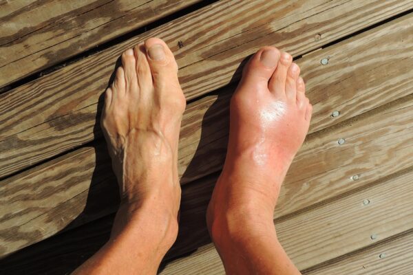 Groundbreaking Study Shatters Gout Myths: Genetics, Not Lifestyle, To Blame