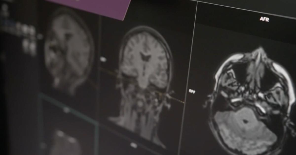 Heart health at young age linked to risk of dementia