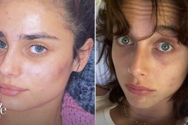 8 celebrities who struggle with acne: from Camila Cabello and Lucy Hale to Pete Davidson and Emma Chamberlain – but which actor lost a role in The O.C. due to their skin condition?
