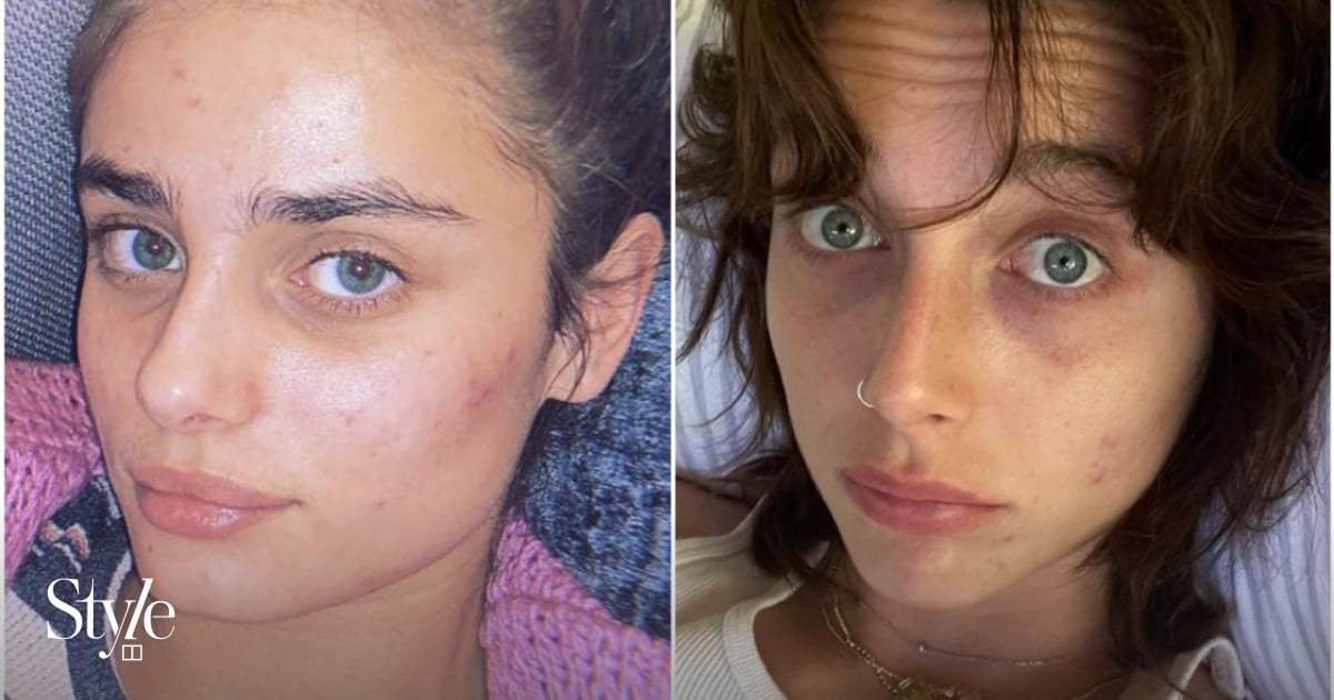 8 celebrities who struggle with acne: from Camila Cabello and Lucy Hale to Pete Davidson and Emma Chamberlain – but which actor lost a role in The O.C. due to their skin condition?