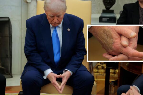 White House explains bruise on Trump's hand: 'Man of the people'