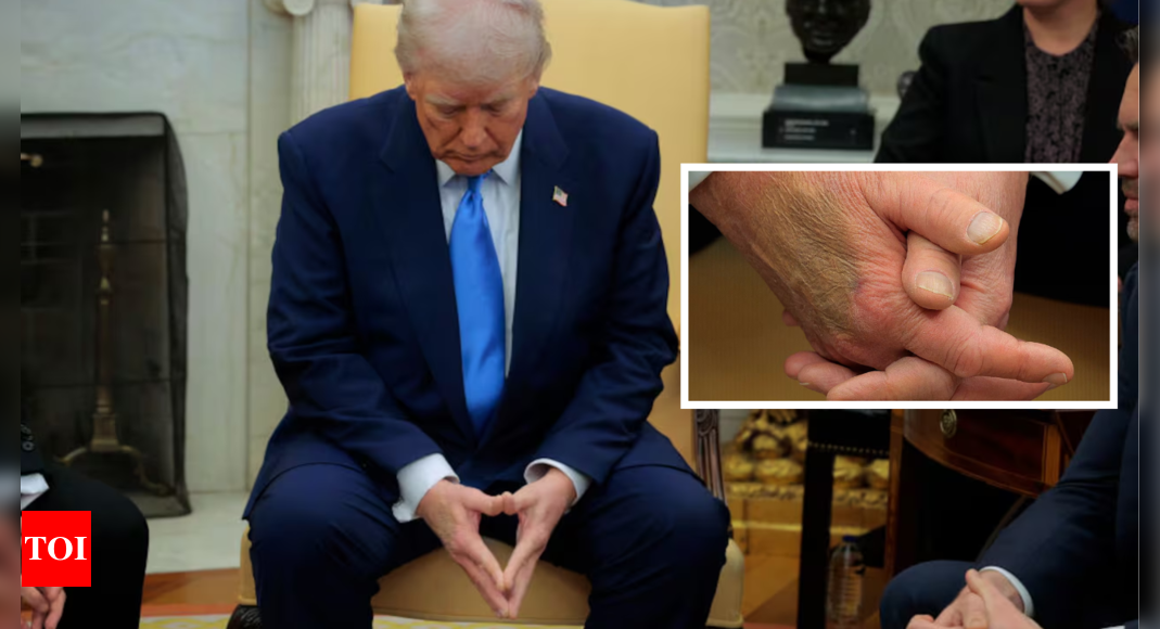 White House explains bruise on Trump's hand: 'Man of the people'