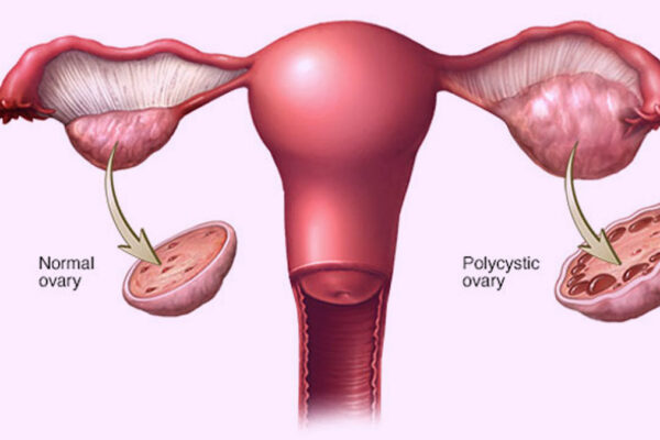 Expert Shares 5 Dinner Ideas To Lose PCOS Belly Fat While Enjoying Your Favourite Foods Rida Hijab