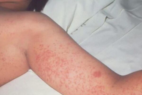 Measles outbreak in Texas rises to at least 48 cases — the state's worst in nearly 30 years