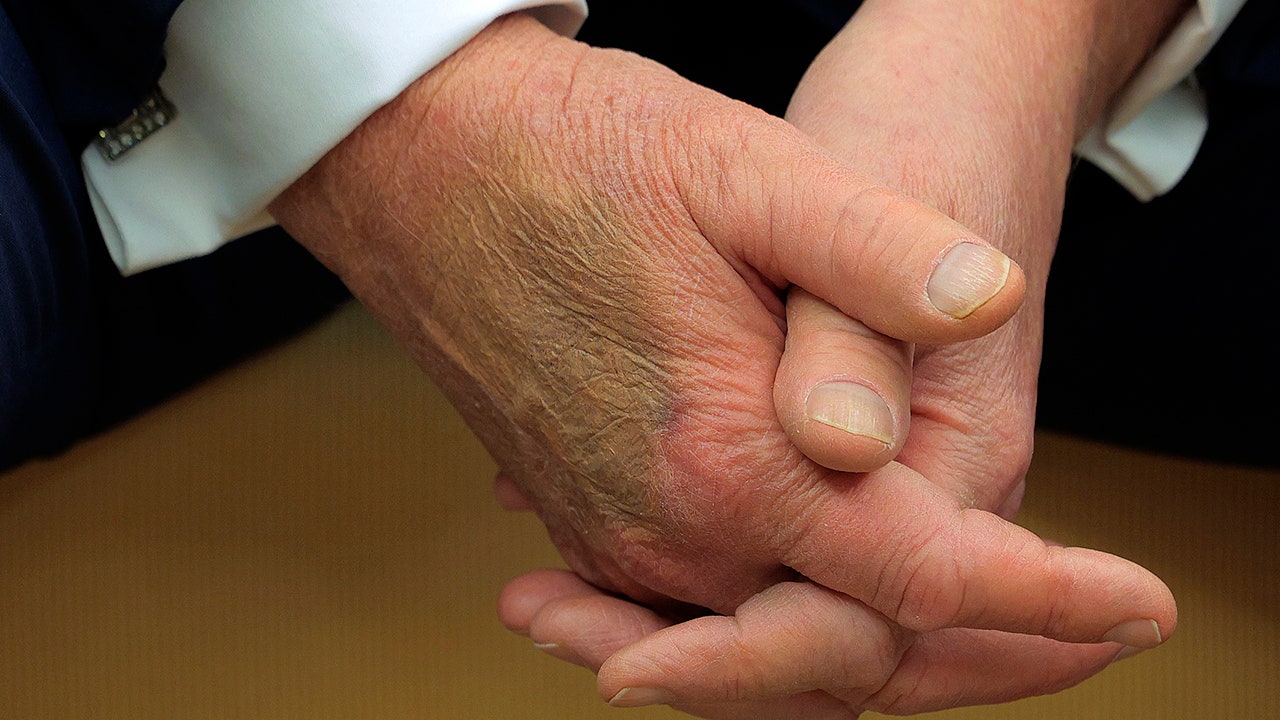 White House explains bruise on Trump's hand
