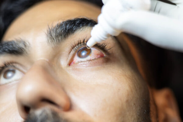 Glaucoma is often associated with increased eye pressure (Representational Image)