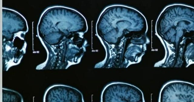 How Trump health agency cuts could impact Alzheimer's research and patients