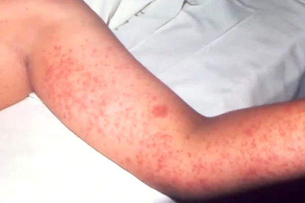 Weekly measles cases hit new record amid worst outbreak since 1990s