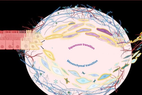 Bowel cancer cells can ‘shapeshift’ to enable aggressive spread, research finds