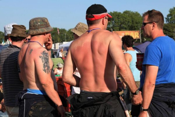 Minister criticises UK’s ‘obsession’ with ‘laughing’ about sunburn