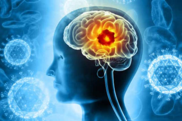 World Brain Tumor Day 2025 — Tips To Lower Brain Tumor Risk And Protect One’s Health World Brain Tumor Day 2025 On 8 June Tips To Lower Brain Tumor Risk And Protect One