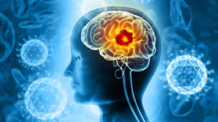 World Brain Tumor Day 2025 On 8 June Tips To Lower Brain Tumor Risk And Protect One