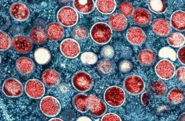 Mpox in the United States and Around the World: Current Situation | Mpox