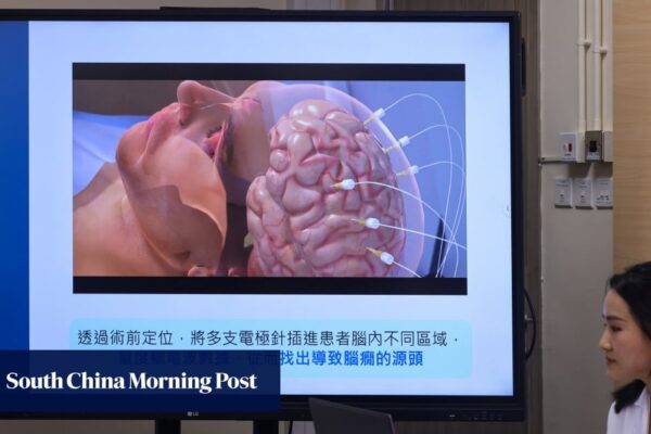 How a Hong Kong man’s drug-resistant epilepsy was relieved using robotics How a Hong Kong man’s drug-resistant epilepsy was relieved using robotics