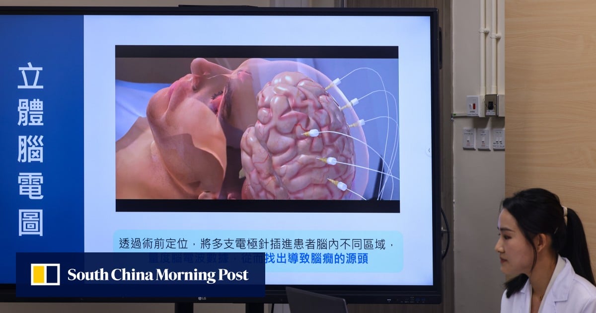 How a Hong Kong man’s drug-resistant epilepsy was relieved using robotics