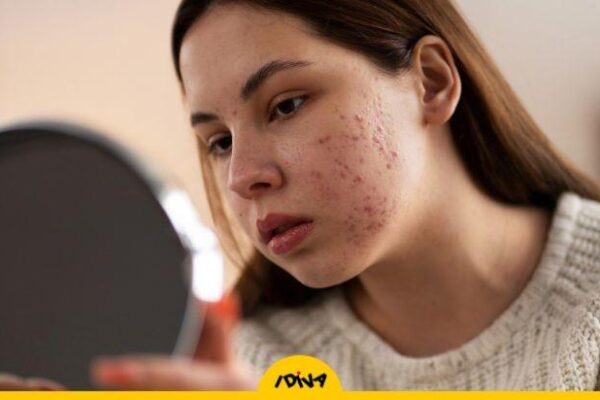 Experts Explain If Acne Is Caused By What We Eat