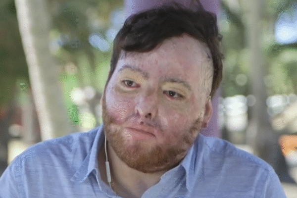 U.S. citizen billed $1.7 million by government for life-saving burn treatment: "Completely hopeless"