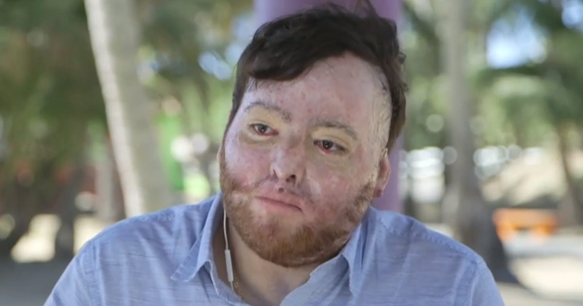 U.S. citizen billed $1.7 million by government for life-saving burn treatment: "Completely hopeless"