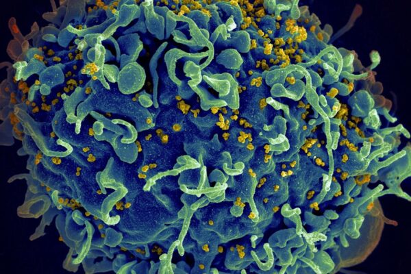 This colorized electron microscope image provided by the U.S. National Institutes of Health shows a human T cell, in blue, under attack by HIV, in yellow, the virus that causes AIDS. (Seth Pincus, Elizabeth Fischer, Austin Athman/National Institute of Allergy and Infectious Diseases/NIH via AP, File)