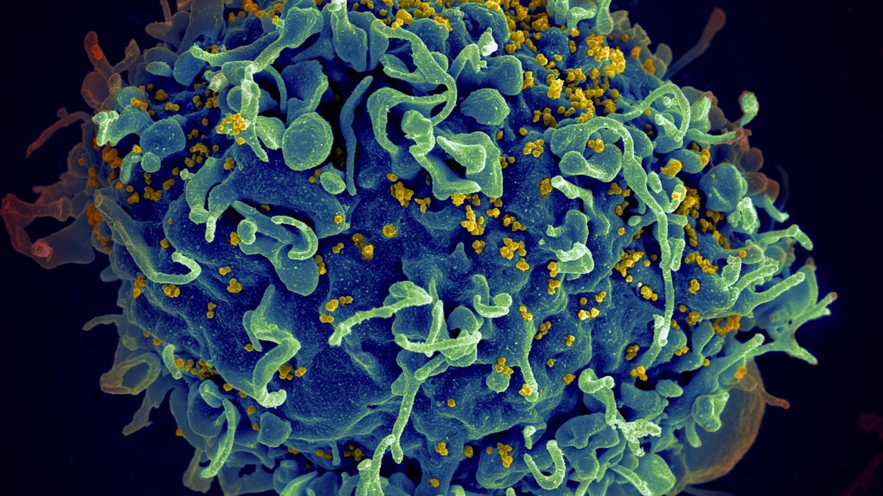 This colorized electron microscope image provided by the U.S. National Institutes of Health shows a human T cell, in blue, under attack by HIV, in yellow, the virus that causes AIDS. (Seth Pincus, Elizabeth Fischer, Austin Athman/National Institute of Allergy and Infectious Diseases/NIH via AP, File)
