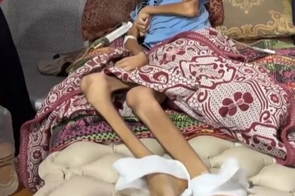 Disturbing images of starvation in Gaza Disturbing images of starvation in Gaza