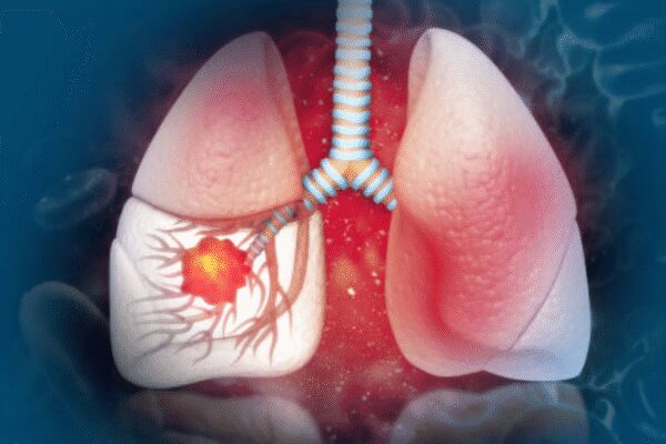 Lifestyle and lung cancer link: How daily choices raise or lower your risk |