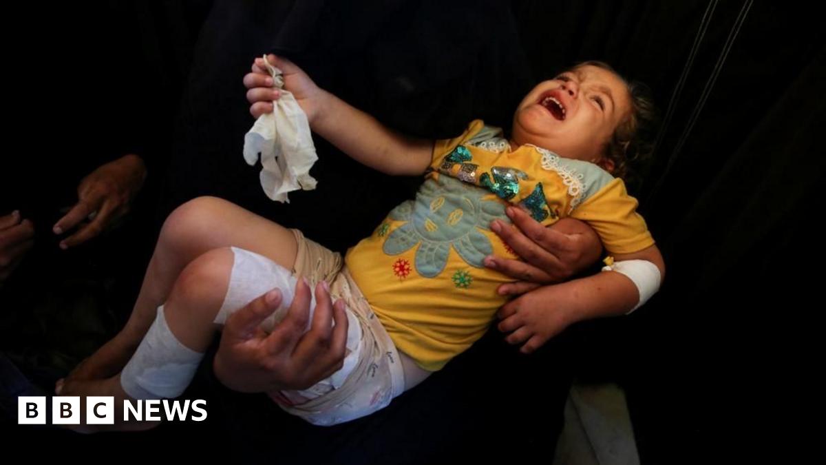 An injured toddler cries as they are being carried with bandages over their arm and legs