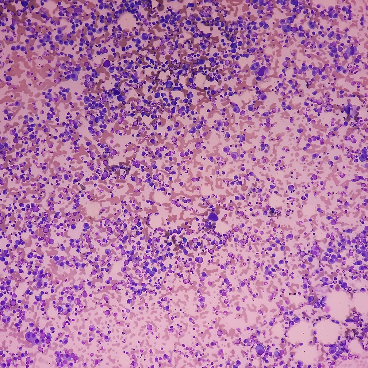 Nurses, APPs Key to AE Management as T-Cell Engagers Move Into Solid Tumors