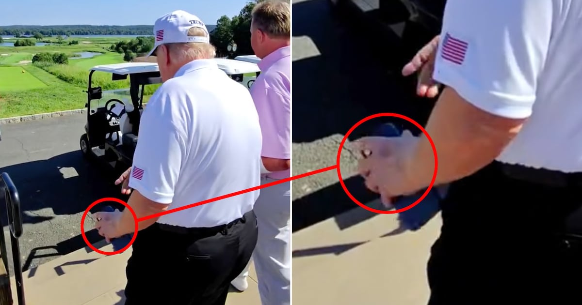 Donald Trump, 79, Spotted With New Bruise on His Other Hand