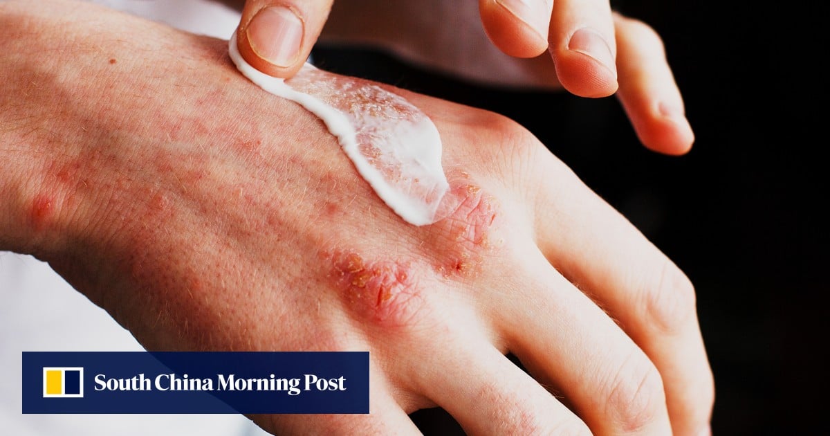 1 in 3 eczema patients in Hong Kong face workplace hostility: poll