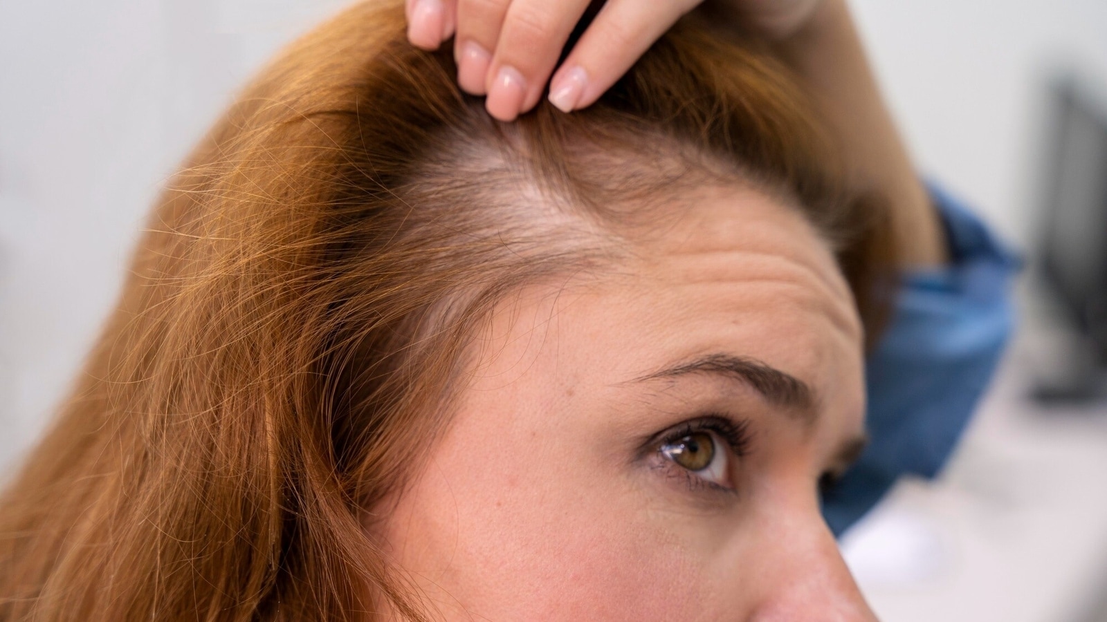 Sudden hair loss and hair thinning? Dermat shares 3 medical conditions that can trigger alopecia | Health