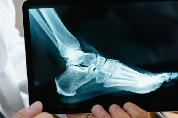 Orthopedic surgeon shares 3 strategies to maintain bone health and prevent age-related frailty | Health