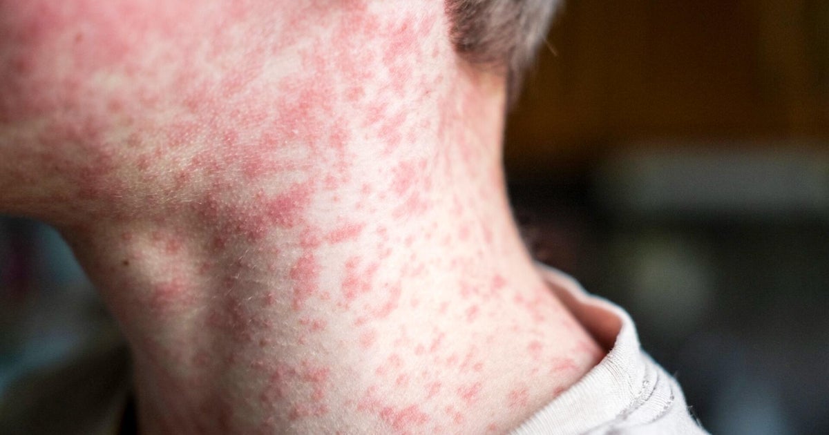 153 unvaccinated students quarantining after measles exposure at South Carolina schools