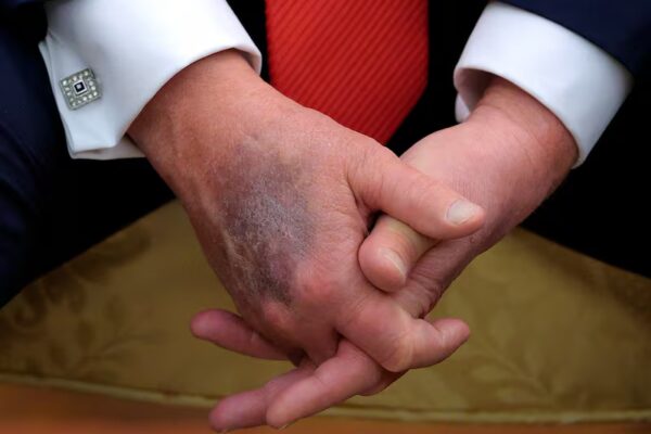 WASHINGTON, DC - AUGUST 25: A bruise is visible on the back of U.S. President Donald Trump's right hand during a meeting with  South Korean President Lee Jae-myung in the Oval Office at the White House on August 25, 2025 in Washington, DC. White House Press Secretary Karoline Leavitt was asked about the bruising in February and she responded, "President Trump has bruises on his hand because he’s constantly working and shaking hands all day every day." (Photo by Chip Somodevilla/Getty Images)