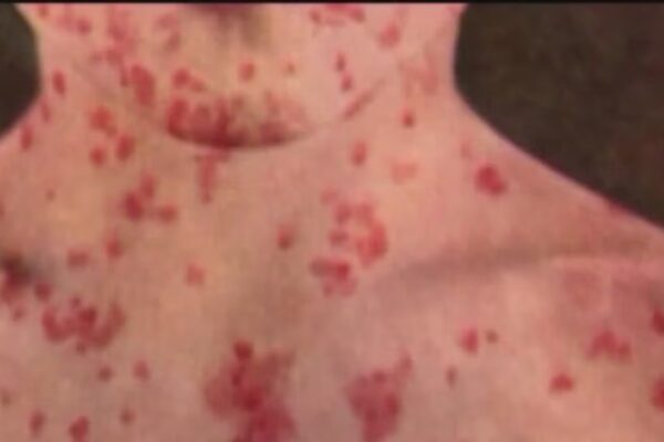 Measles cases rising nationwide