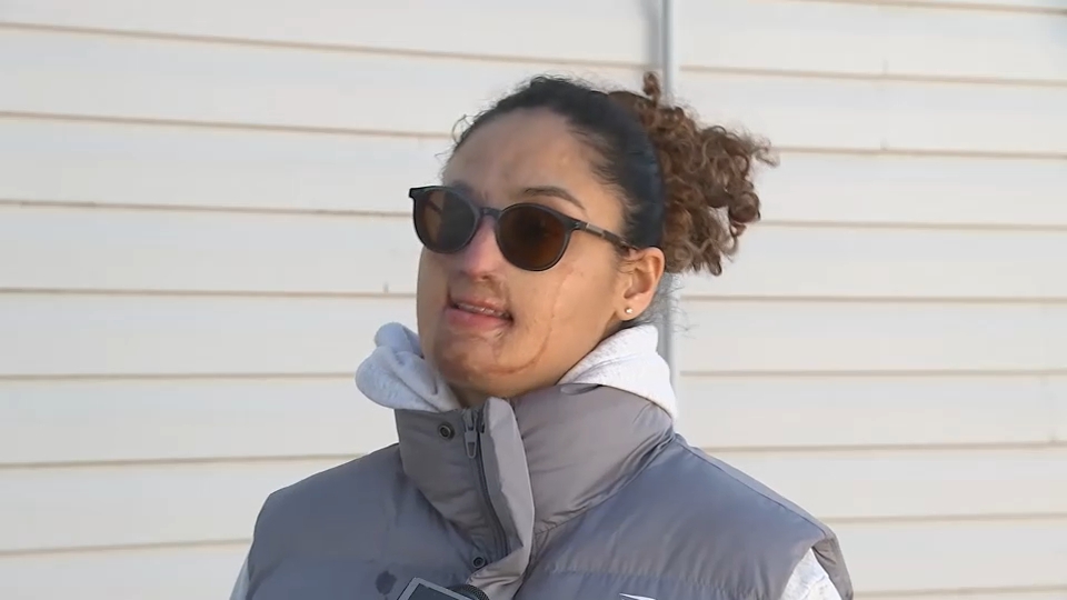 Long Island acid attack arrest: Arrest made years after young woman assaulted in Elmont, Nassau County in 2021