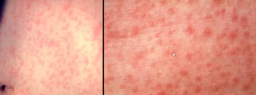 Hong Kong reports first locally acquired measles case of the year