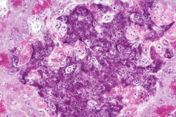 A close up of the pancreas, where purple and pink stained cells can be seen with dark dots for their nucleii