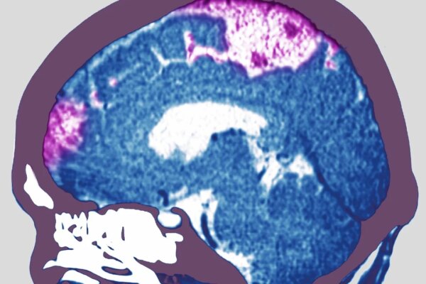 Why Hong Kong scientists think GLP-1 weight-loss drugs can help stroke patients