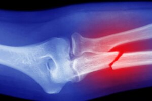 University to roll out screenings at pharmacies to uncover osteoporosis cases